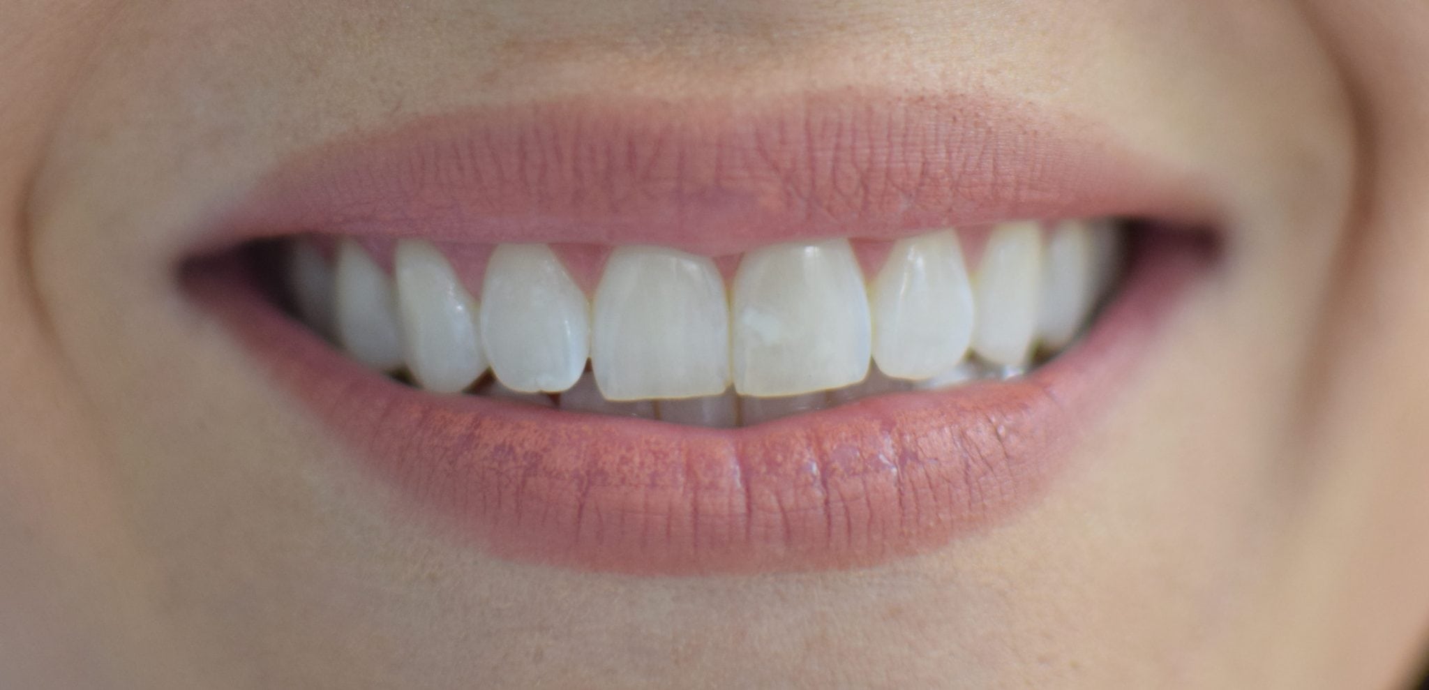teeth after using smile brilliant