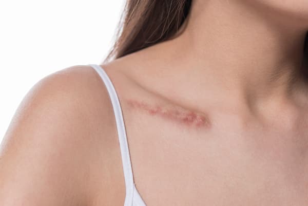 A woman with a scar on her collarbone.