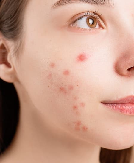 A woman with acne on her face.