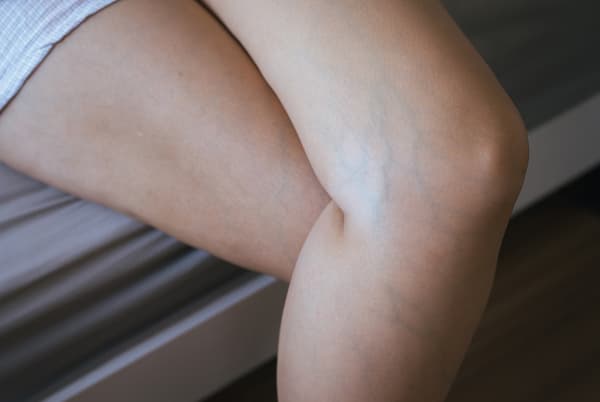 A womans legs  with varicose veins