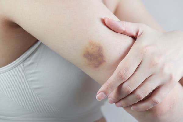 A woman with a bruise on her arm.
